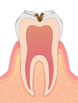 神経に近いむし歯
