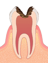 神経に到達したむし歯