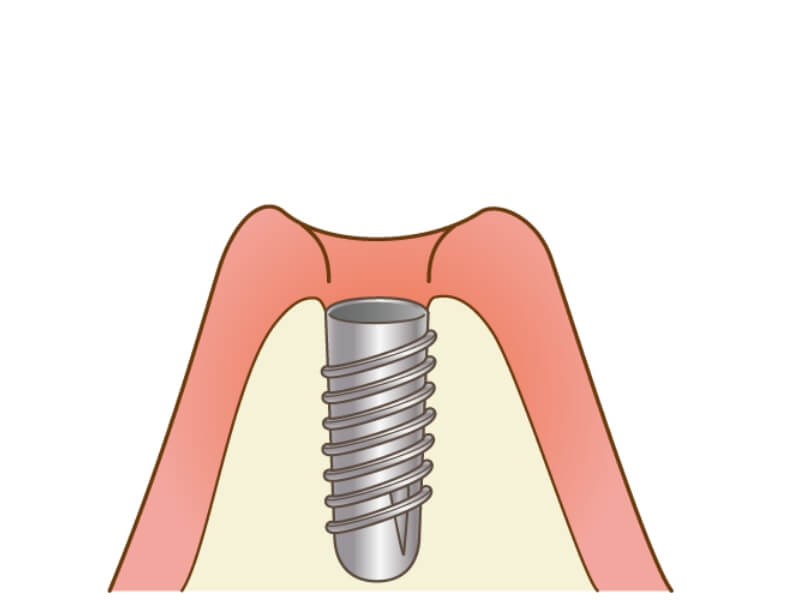 インプラント手術​
